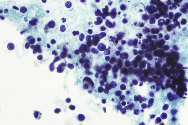 小细胞肺癌的Micrograh