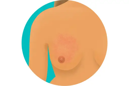 胸部橙皮外观图
