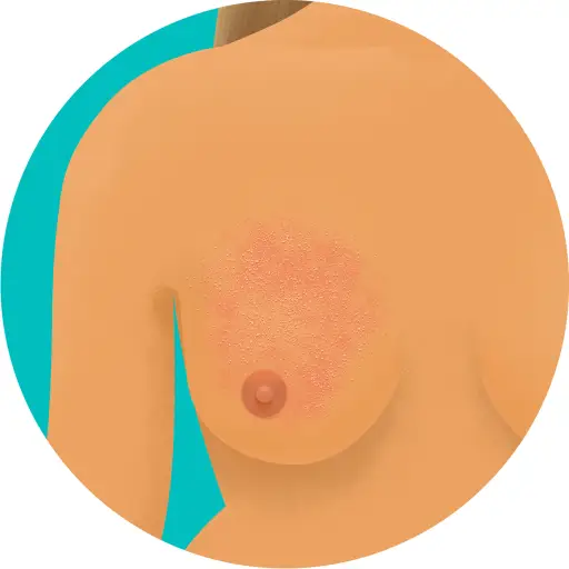 胸部橙皮外观图示