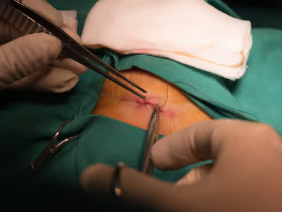医生膀胱部分切除后缝合切口。