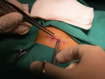 外科医生在部分膀胱切除术后缝合切口。
