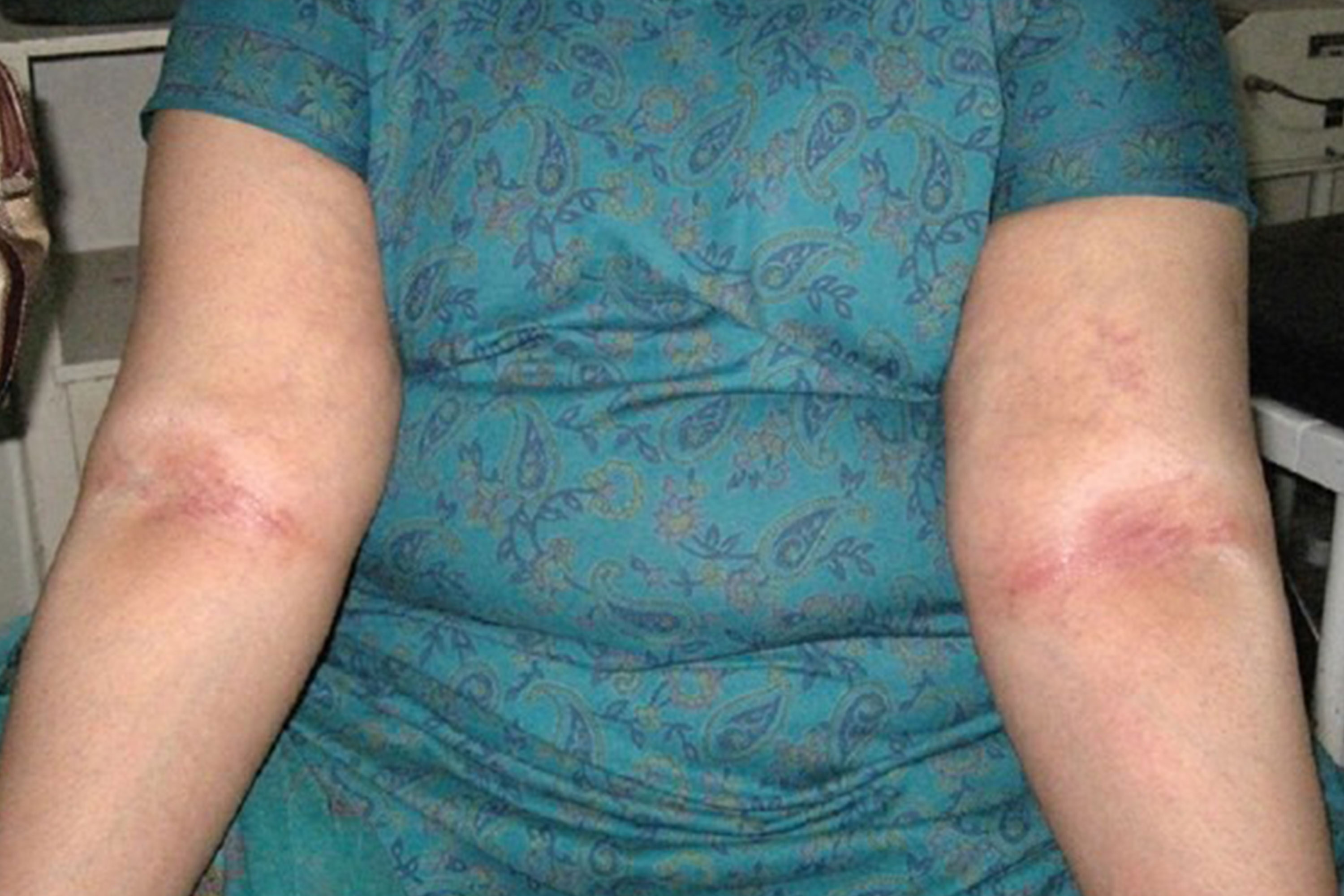 eczema bumps on elbows