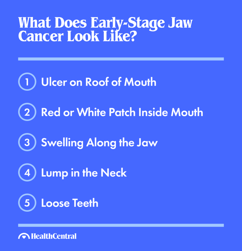 早期的下颚癌看起来像上颚的溃疡，口腔内有红色或白色的斑块，沿下颚肿胀，颈部有肿块，牙齿松动
