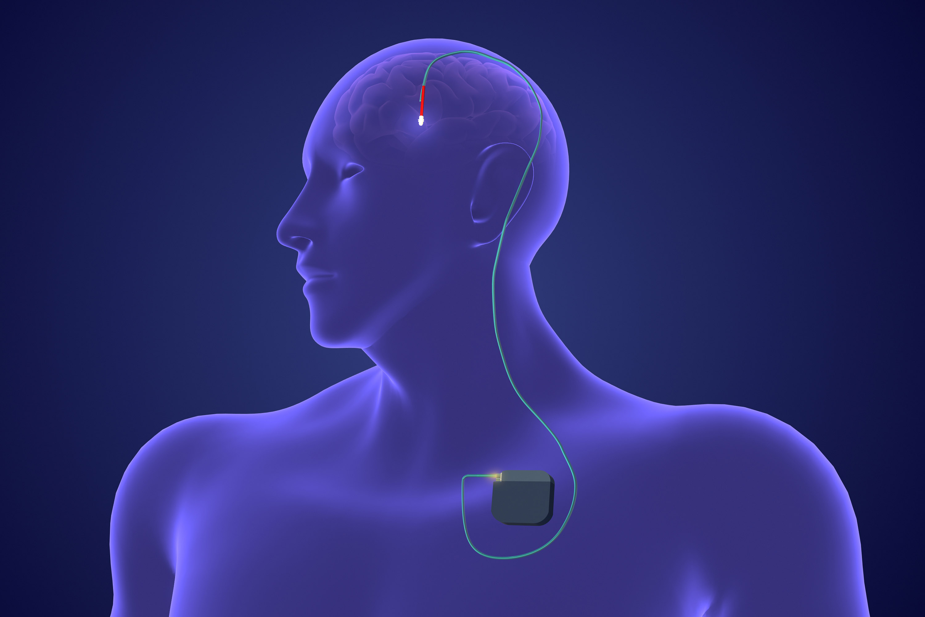 Deep Brain Stimulation for Multiple Sclerosis