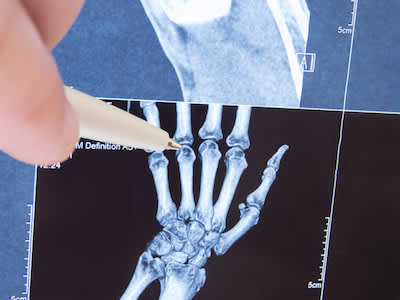 放射科医生检查手部小关节的x光片，以诊断关节炎。