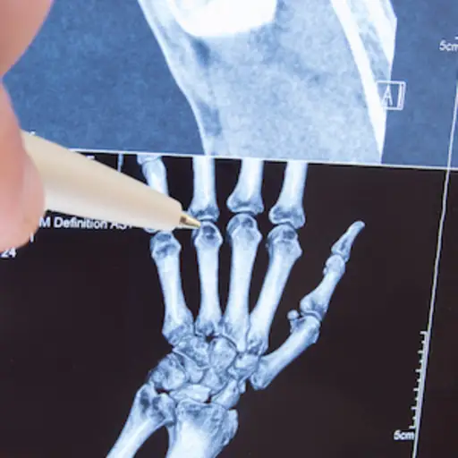 用x光片检查手小关节的放射学家，以诊断关节炎。