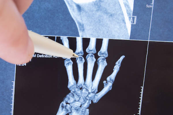 放射科医生检查手部小关节的x光片,以诊断关节炎。