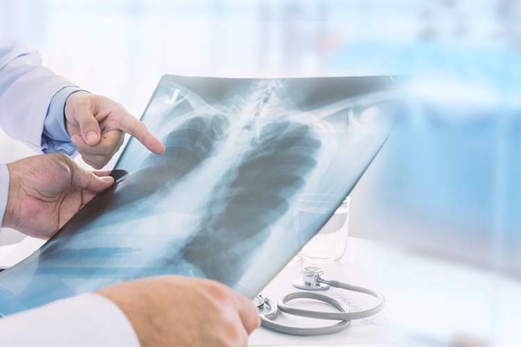 医生在看肺部x光片。