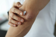 4 Step Psoriasis Flare Action Plan