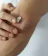 牛皮癣奶油