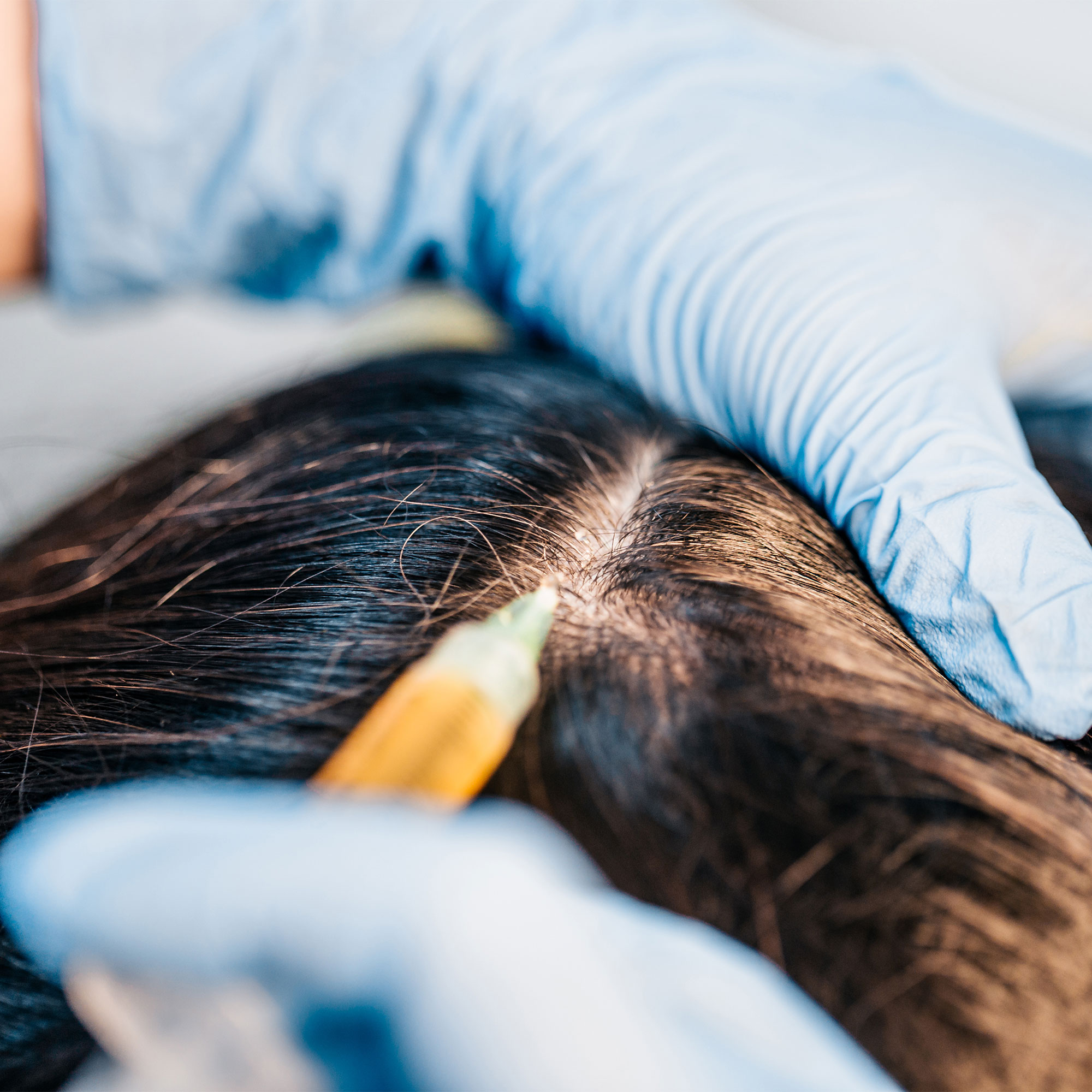 被注射的头皮特写