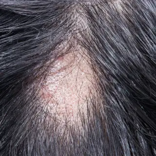alopecia areata treatment injection