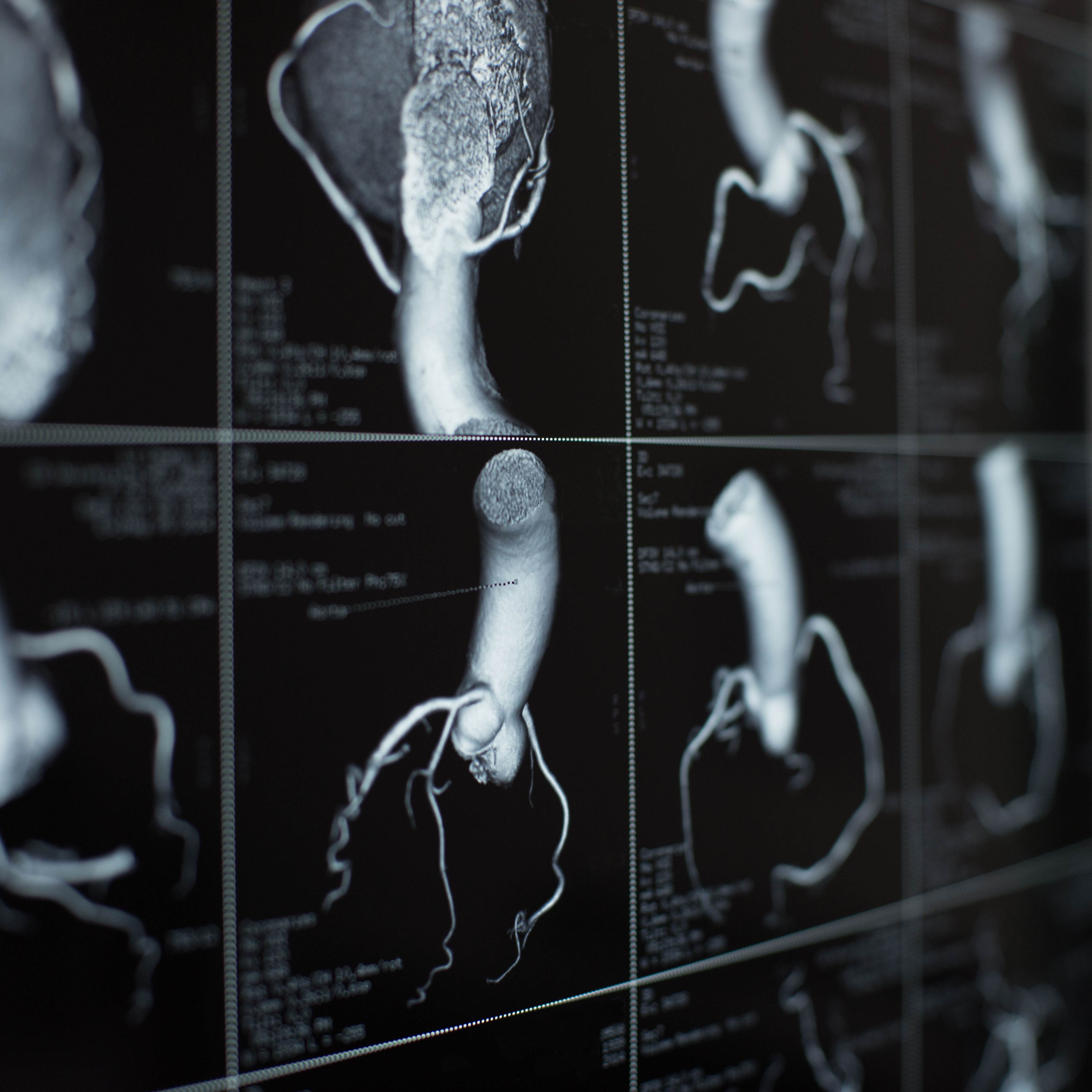 心脏和冠状动脉的CT扫描