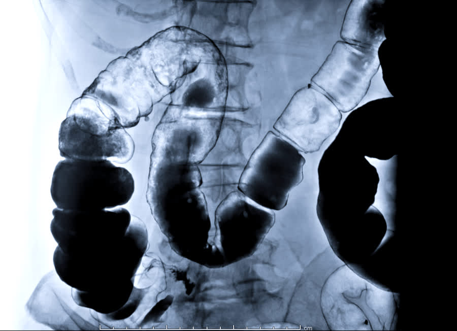 Crohns Disease Testing Options And Diagnosis