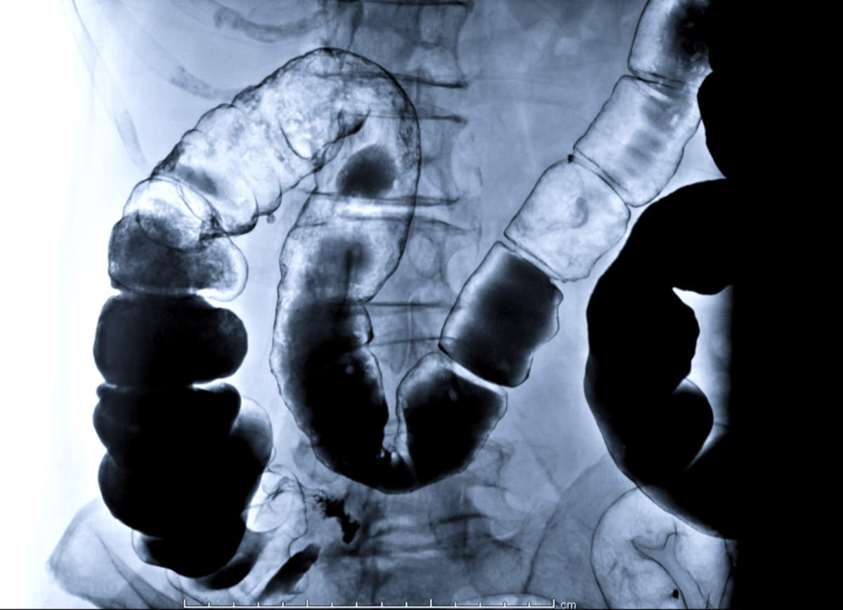 Crohn's Disease Testing Options and Diagnosis
