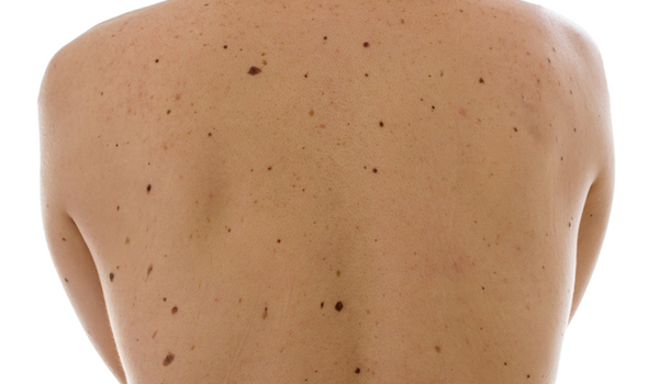 atypical-mole-syndrome-skin-cancer