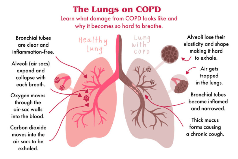 COPD上的肺部