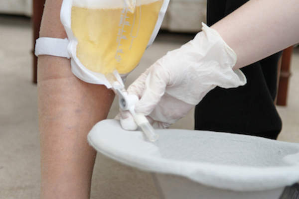 护士引流膀胱癌患者的导管袋。