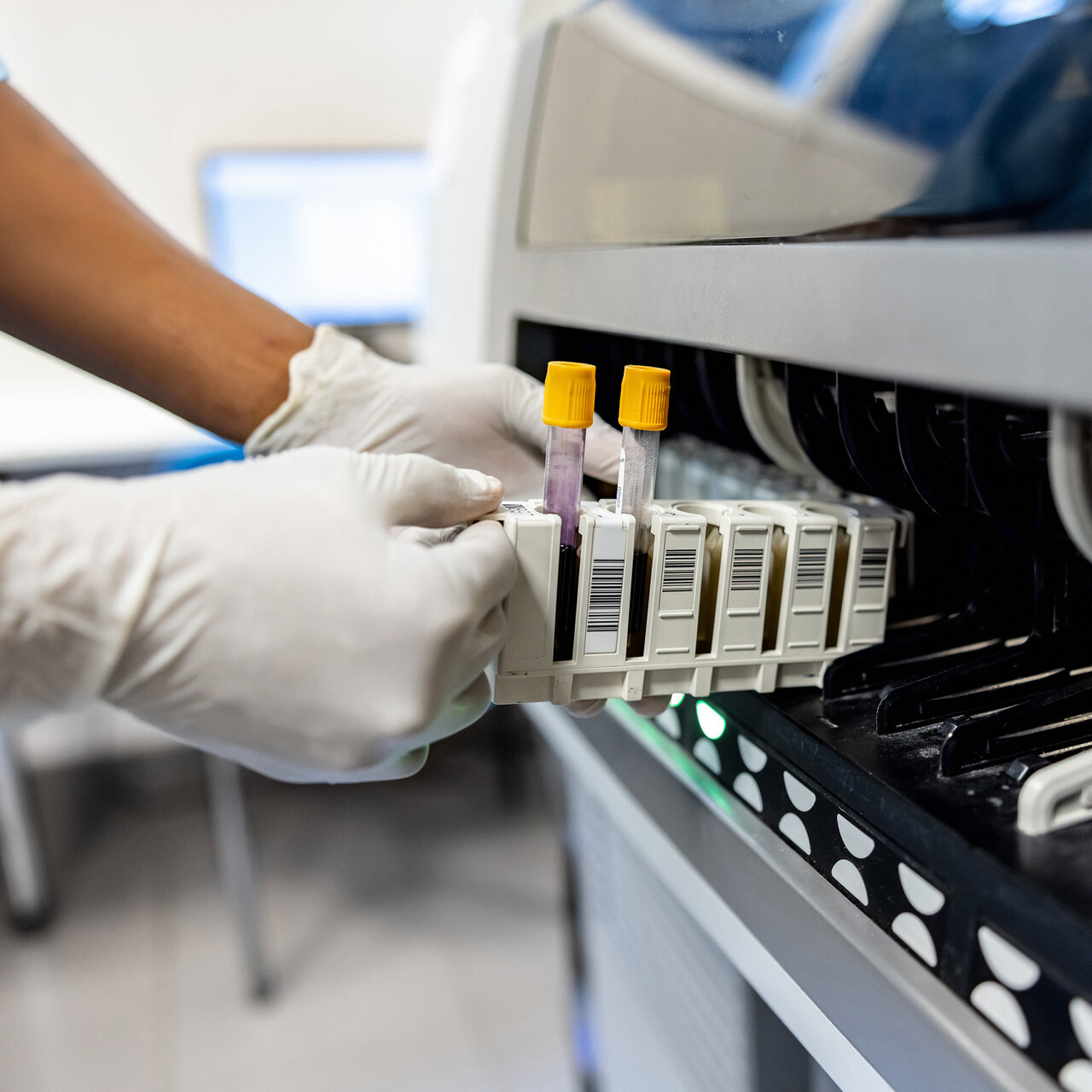 How Doctors Monitor Bone Loss With Osteoporosis