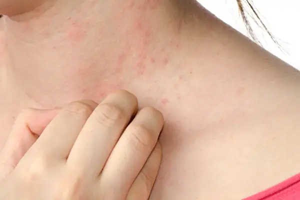 水痘 故事 新闻和专家建议 Ayx连串过关 水痘 故事 新闻和专家建议 Ayx连串过关