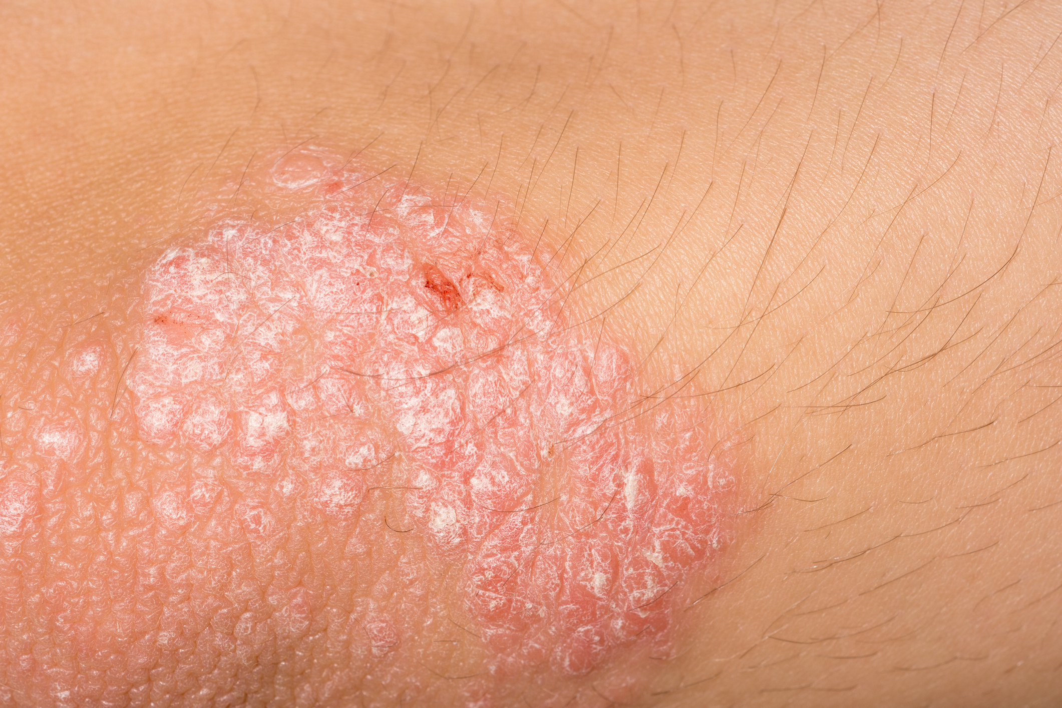 is psoriasis infectious