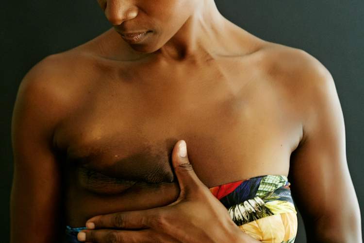 做过单侧乳房切除术的女性