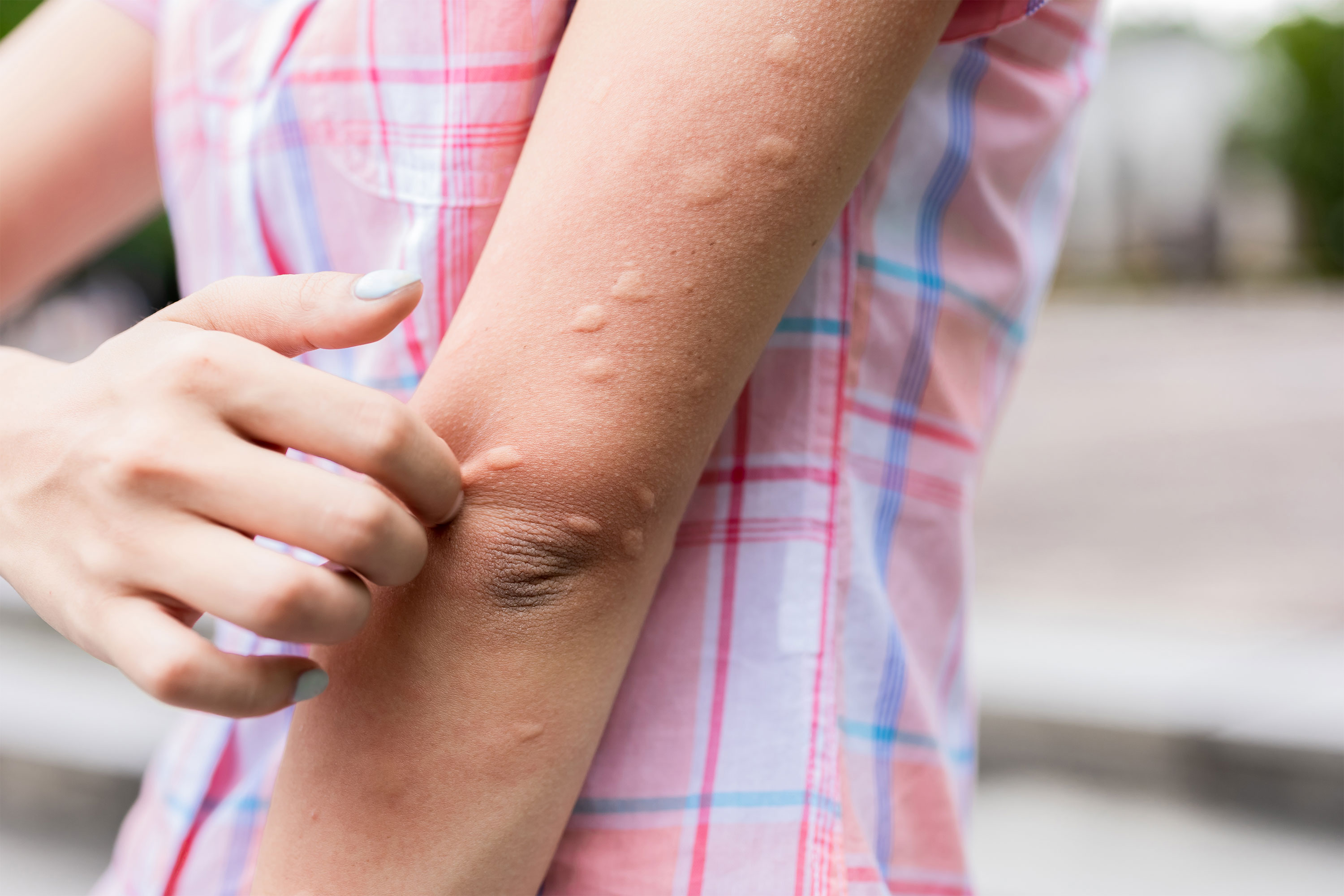 How to Tell the Difference Between Bug Bites, Heat Rash, and Hives