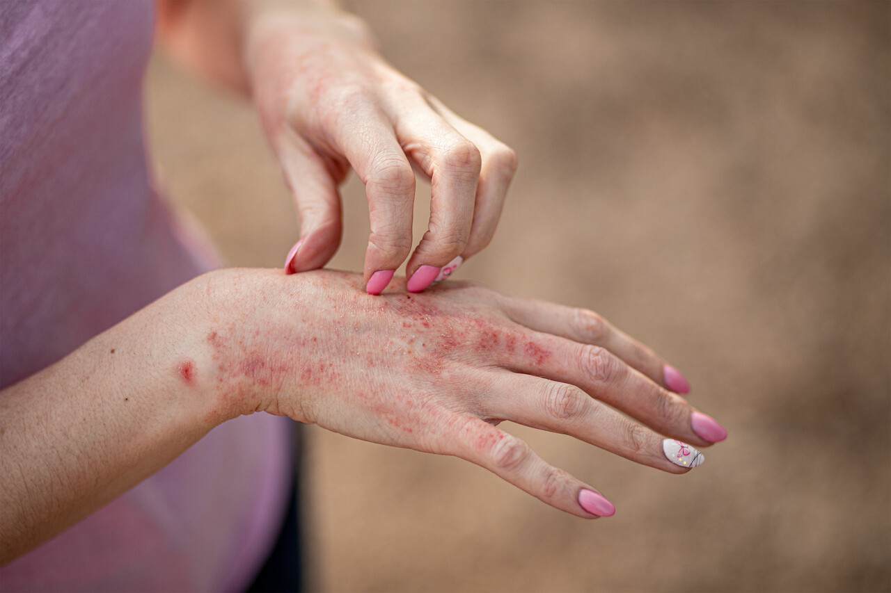 Atopic dermatitis treatment: Could dust mite extract help?