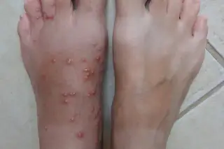 infected mosquito bite blister