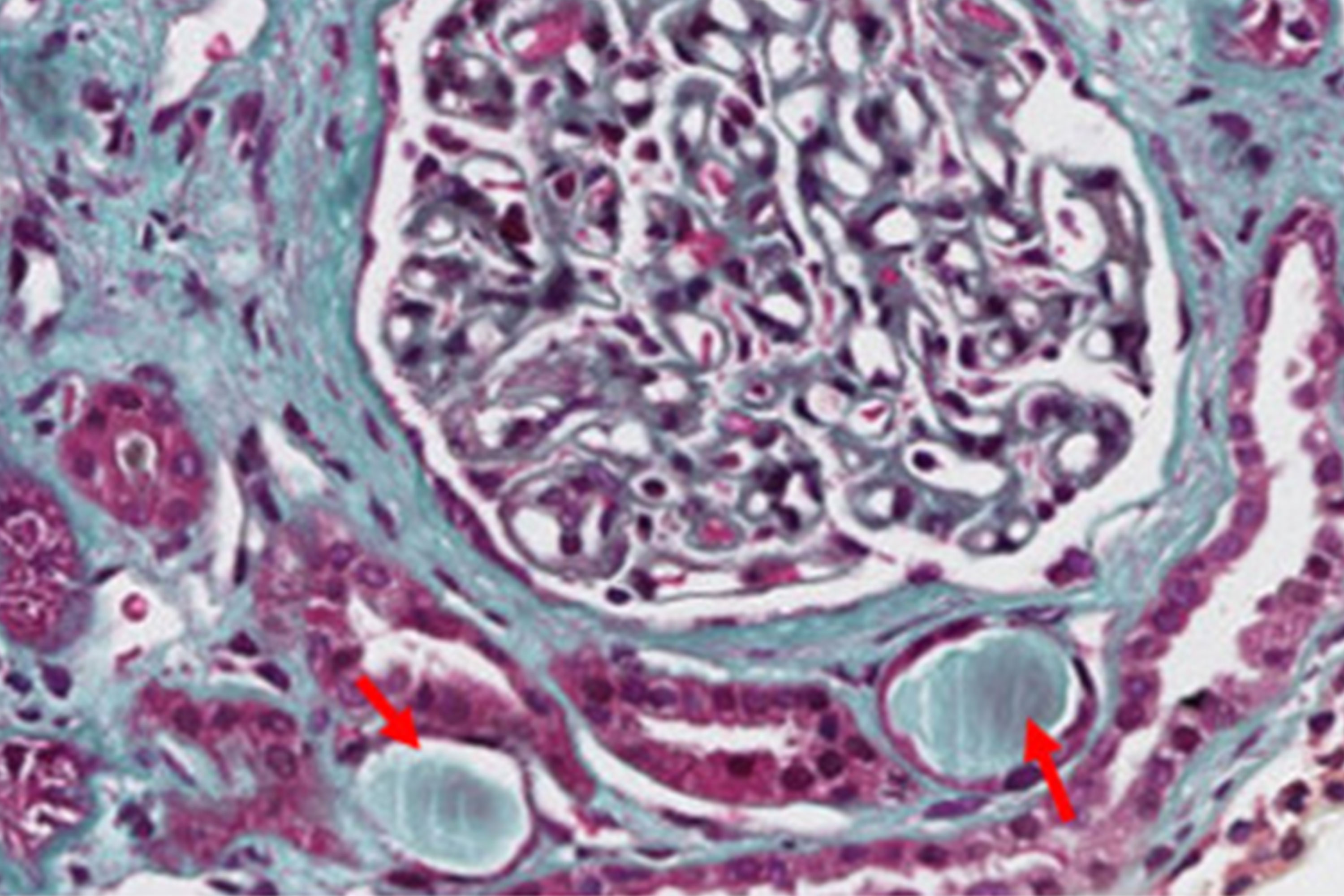 What is a Cholesterol Embolism?