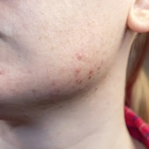 Papulopullular rosacea.