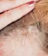 头皮银屑病