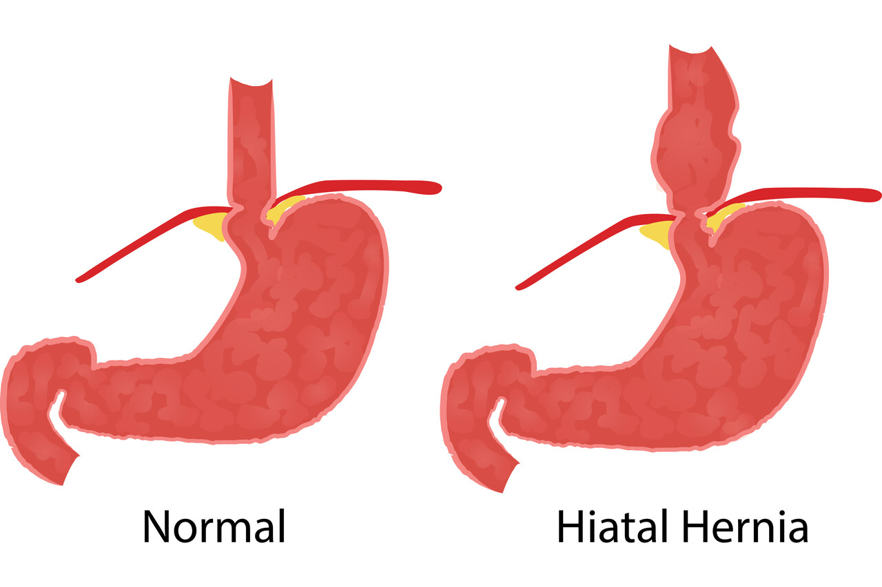 What's the Normal Weight Loss After Hiatal Hernia Surgery?