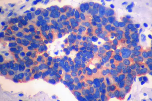小细胞肺癌的嗜铬粒蛋白免疫染色