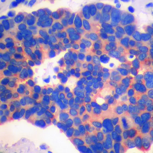嗜铬粒免疫染色用于小细胞肺癌