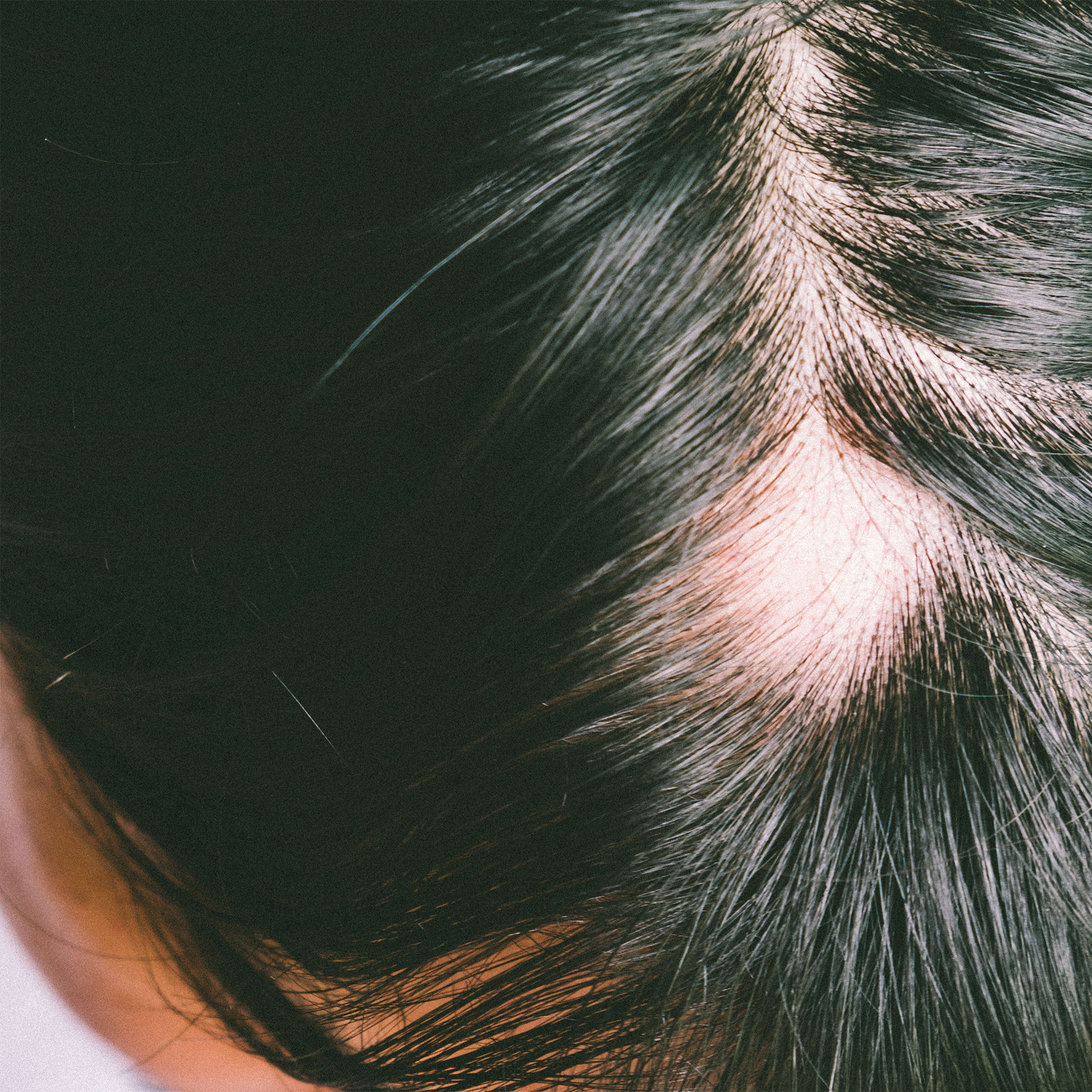 脱发秃斑的视图