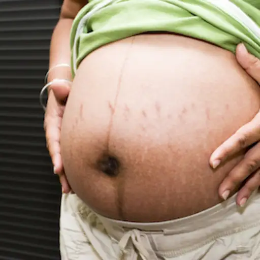 怀孕的肚子上有妊娠纹。