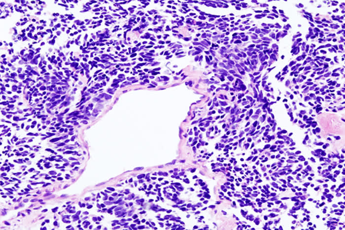 肺小细胞癌的组织病理学影像