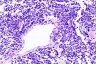 肺小细胞癌的组织病理学图像