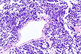 肺小细胞癌的组织病理学表现