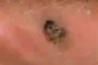 Acral Lentiginous Melanoma (ALM) on skin