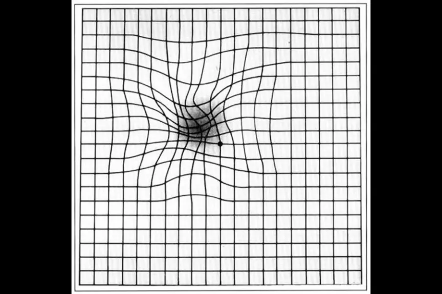Amsler grid as it might appear to someone with age-related macular degeneration.
