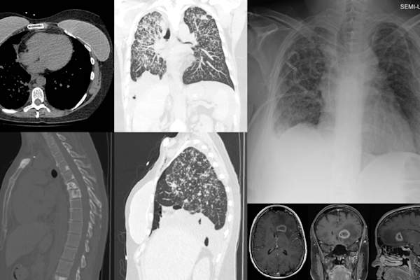 与转移到脑,肺和骨骼乳腺癌
