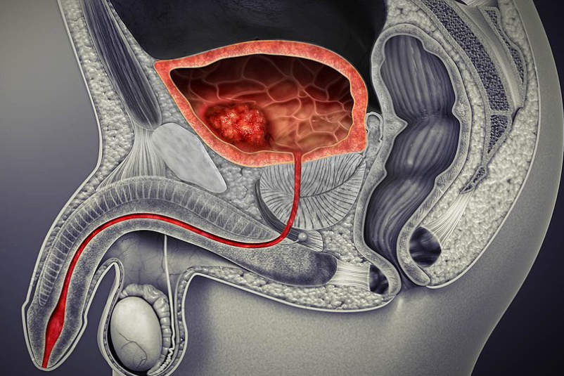 膀胱癌的医学图示。