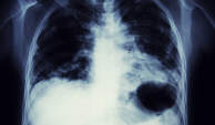 肺癌的X射线图像