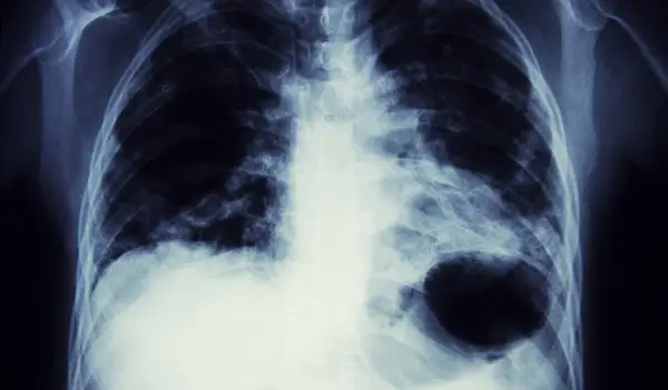 肺癌x射线图象