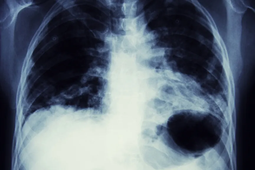 lung cancer x-ray image
