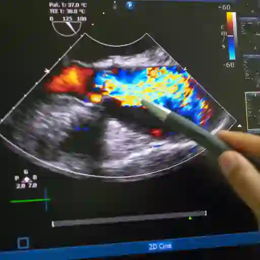 超声心动图检测动脉瘤