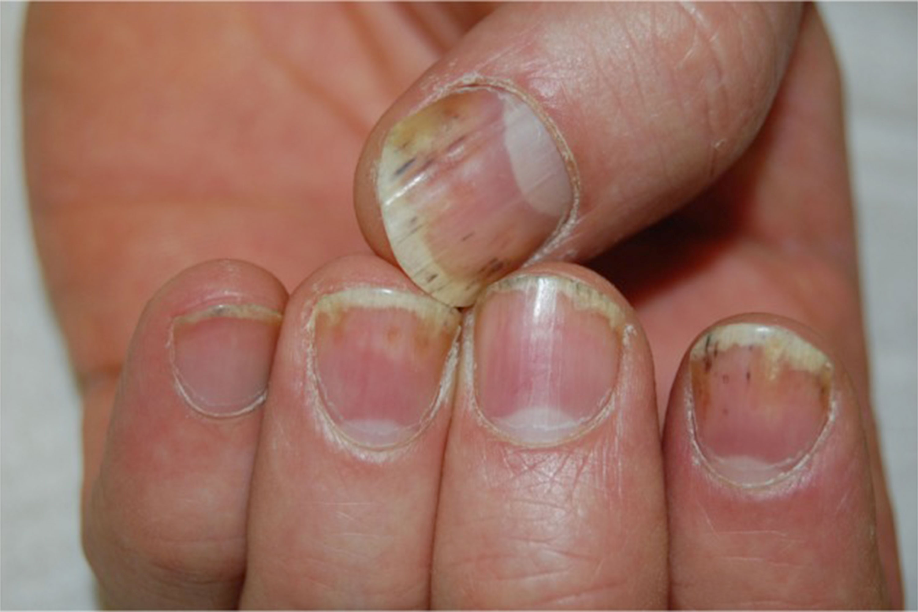 Significant nail pitting and onycholysis are depicted on this image. |  Download Scientific Diagram