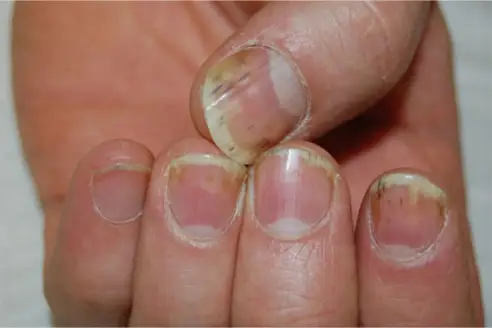 Fingernail psoriasis with onycholysis, subungual hyperkeratosis, salmon spots, and splinter hemorrhages